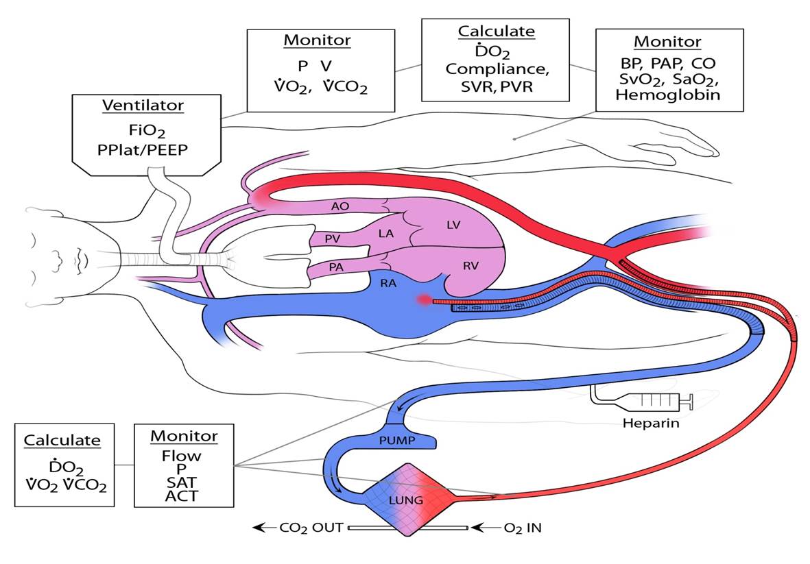 ECMO schematic