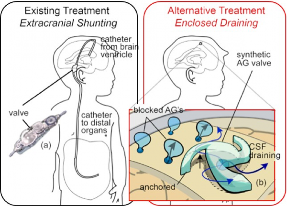 illustration of extracranial shunting and draining