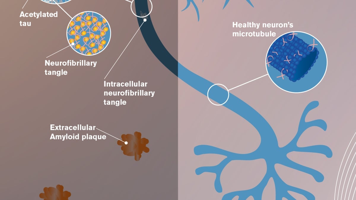 graphic showing the development of neurodegenerative pathology resulting from low levels of the protein Rbbp7