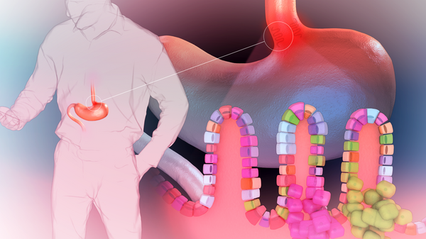 Graphic illustration showing a case of Barrett's esophagus within a person.